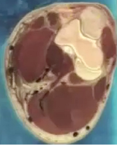 Compares accuracy of 3D print with image of transverse section of elbow from which 3D print was made.